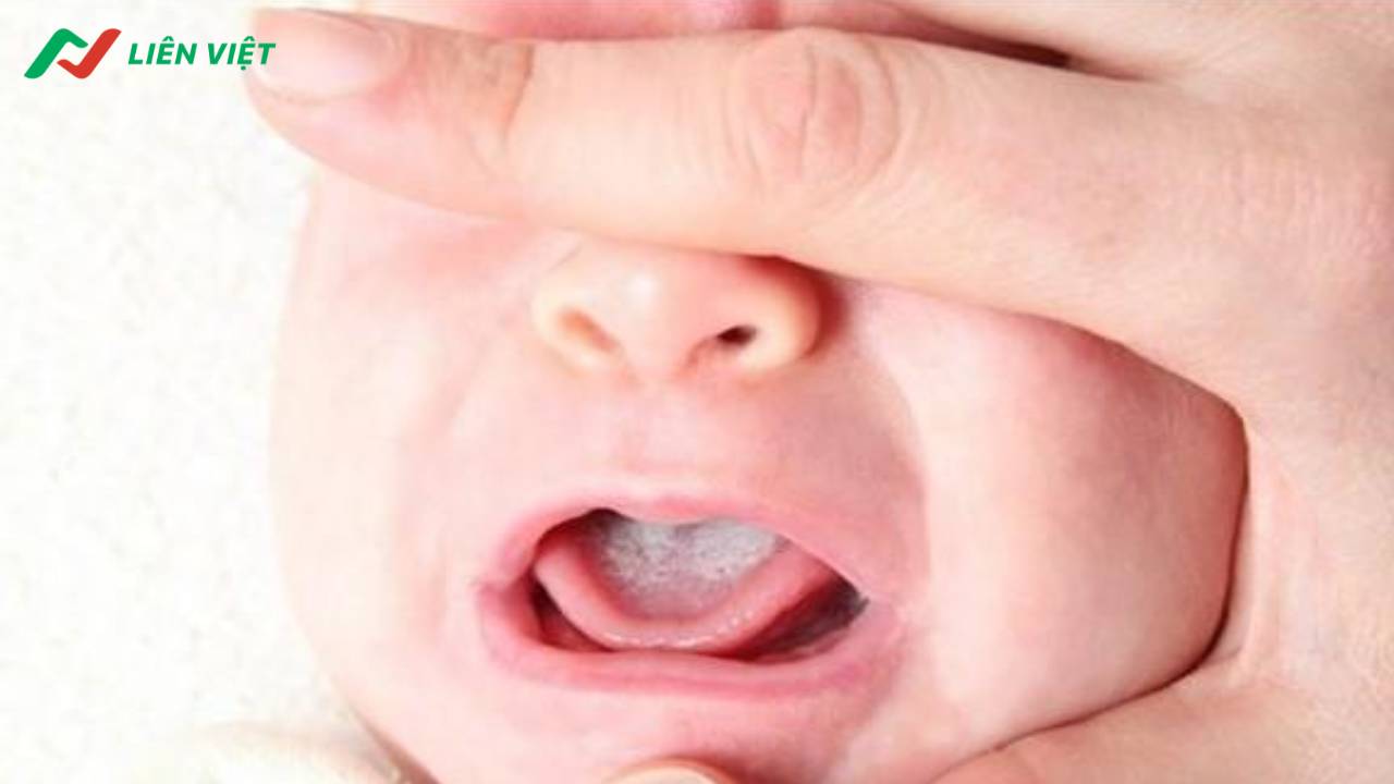 Tưa lưỡi xuất hiện phổ biến ở trẻ nhỏ